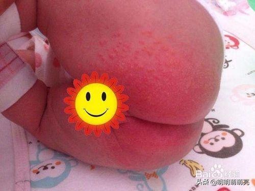 宝宝用啥纸尿裤都红屁股怎么办,宝宝用了纸尿裤红屁股