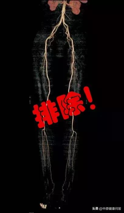 66岁女子为了治疗灰指甲把大脚拇指甲拔掉