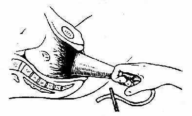 顺产中什么方法助产,助产士教你正确分娩