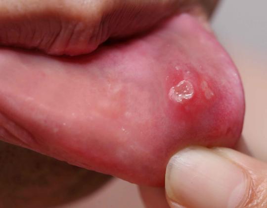 口腔溃疡反反复复怎样治好得快,倪海厦寒湿口腔溃疡最快解决方法