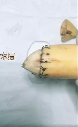 我在快手上看人切洋葱，竟然弄懂了剖腹产？