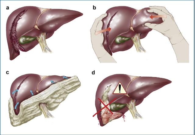 肝脏损伤的诊断和处理,肝脏损伤ii级