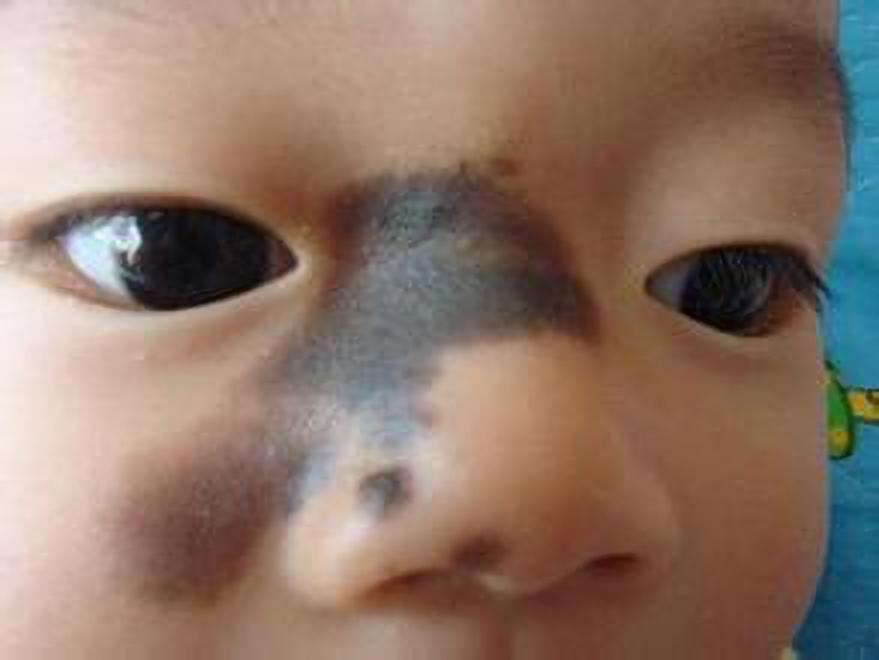 去黑毛痣最好的治疗方法,黑毛痣怎么治疗效果才好呀