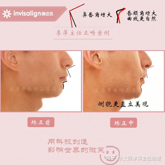 太原牙齿矫正靠谱吗,太原成人隐形牙套牙齿不齐