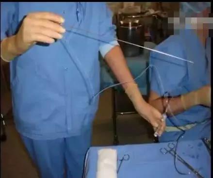 见过被扎过200次的卵巢吗？有女孩的家庭都该看看