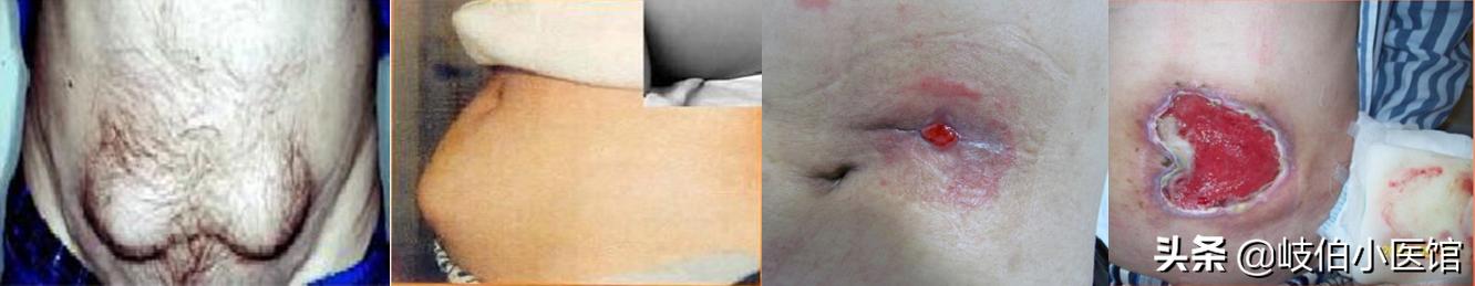 胰岛素怎样注射及剂量,常用胰岛素的注射部位及注意事项