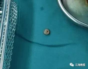 2岁女童误吞纽扣电池有什么反应,12岁女生误吞纽扣电池