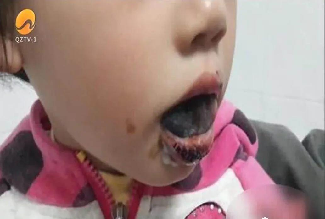 误食高锰酸钾急救,儿童误食高锰酸钾的病例