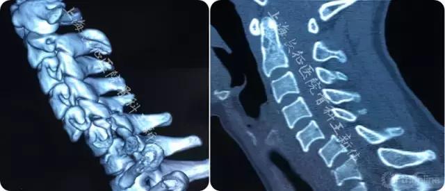 颈椎外伤受损如何治疗,颈椎损伤手术恢复怎么样