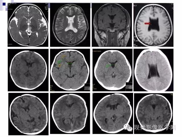 成年人透明隔腔增宽能活多久,透明隔缺如临床意义