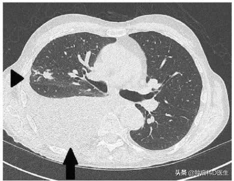 肺癌胸水控制了说明好转了吗,有胸水了还可能是早期肺癌吗