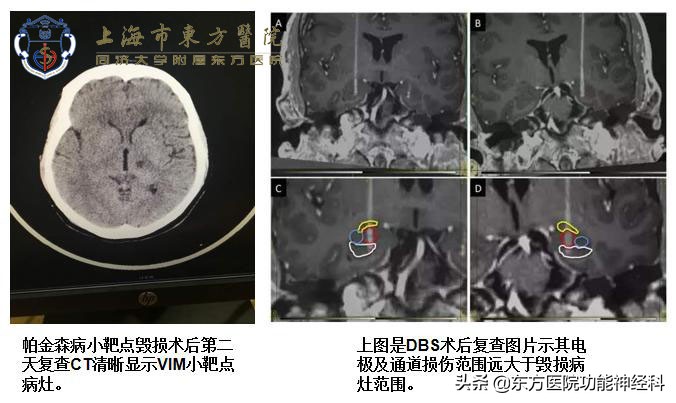 dbs手术与细胞手术,细胞刀和dbs手术的区别