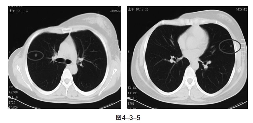 肺癌和乳腺癌哪个治愈率高,乳腺癌肺癌双原发治疗方案