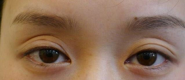 三角眼单眼皮怎么改善,三眼皮怎么改善成双眼皮