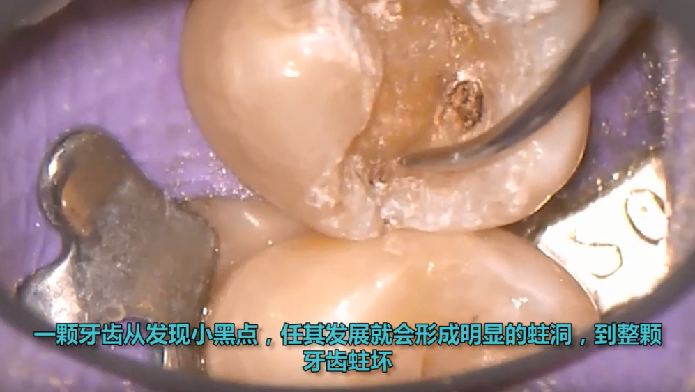 牙齿表面有小黑点内部一定坏了吗,根管治疗后牙齿有小黑点