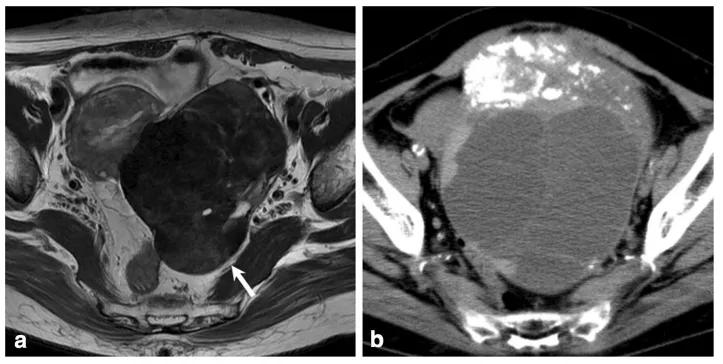 卵巢实性为主肿瘤，这13种你都想到了吗？