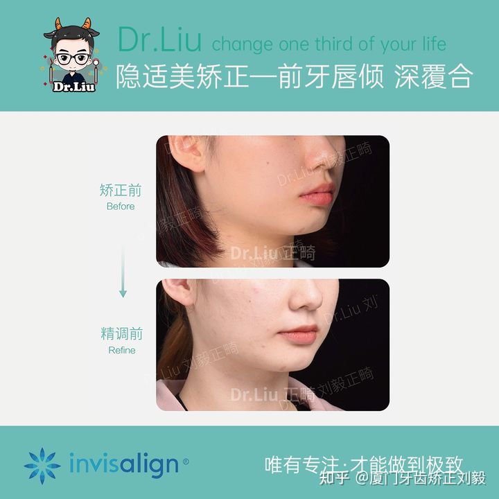 厦门透明牙齿矫正器矫正时间,厦门成人隐形牙齿矫正价格