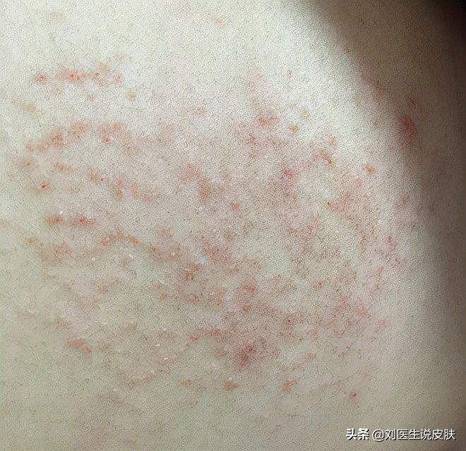 反反复复的湿疹是慢性湿疹吗,湿疹反复怎么调理身体