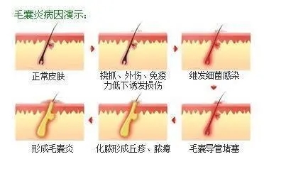 毛囊闭锁三联症怎么彻底治疗,毛囊闭锁三联征北京哪里可以治