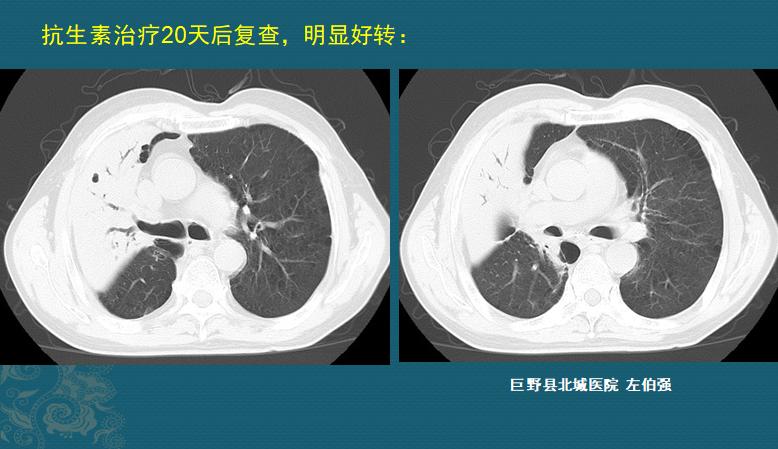 肺炎感染者吐痰,肺炎患者咳大量黄痰最有可能感染