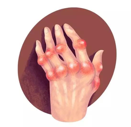 类风湿健康知识讲座方案,类风湿性关节炎干细胞手术全过程