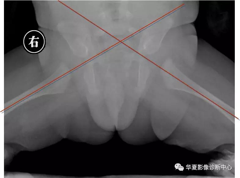 先天性髋关节脱位,先天性髋关节脱位属不属于残疾人