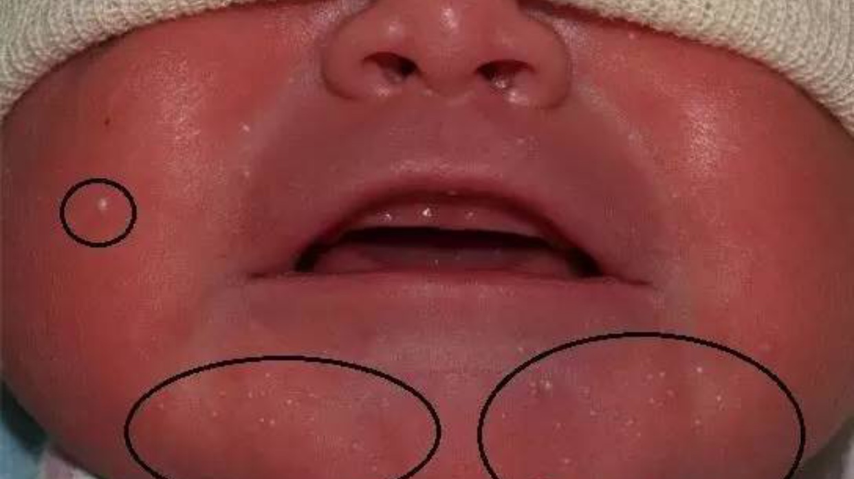 宝宝脂溢性湿疹可以涂什么药膏,宝宝湿疹脂溢性皮炎