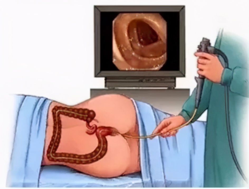 胃肠镜检查前后准备和注意事项,胃肠镜检查流程详解