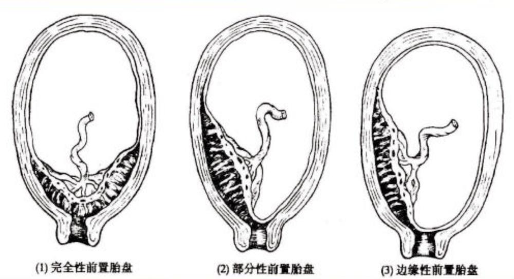 孕妈出血,孕12周胎盘前置有出血该怎么办