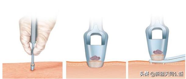 艾滋病初期是皮肤溃烂么,艾滋病会皮肤溃烂表现吗