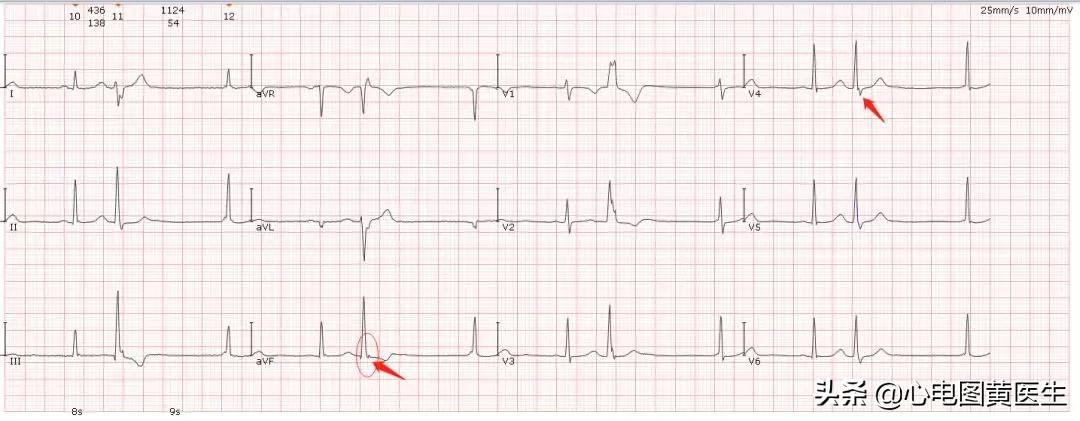 频发室性早搏部分为室性融合波,室性早搏与差异性传导鉴别