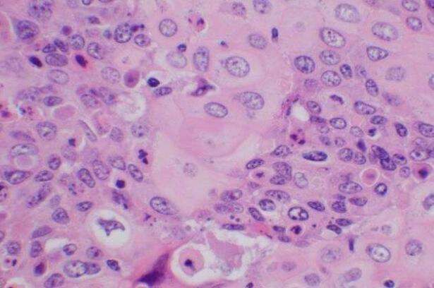 hpv检查e6和e7阳性会影响怀孕么,hpv核酸检测和e6e7检测有什么区别