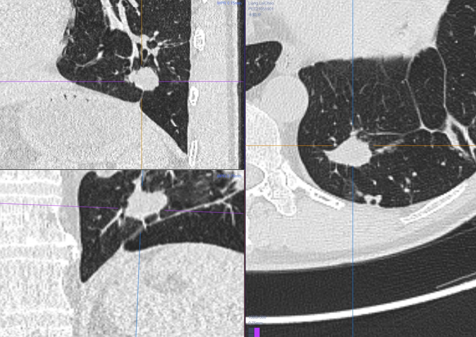 9mm肺结节实性结节良性几率多大,良性肺结节生长速度