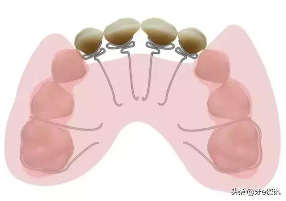 狗狗乳牙地包天怎么办,儿童乳牙地包天怎么办