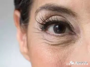 皱纹变多的症状,最近为什么突然有皱纹了