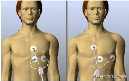 磁共振心脏扫描标准切面,心脏mri扫描定位