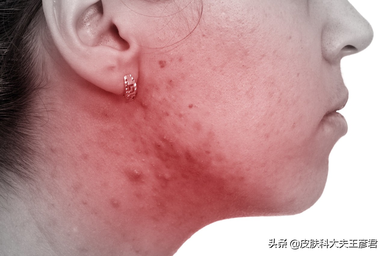 皮肤长了个痘痘变硬了成了个疙瘩,脸上痘痘变硬特别痒是怎么回事