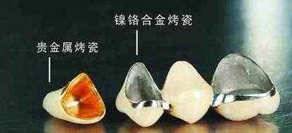 我的烤瓷牙掉了,烤瓷牙崩瓷了怎么办