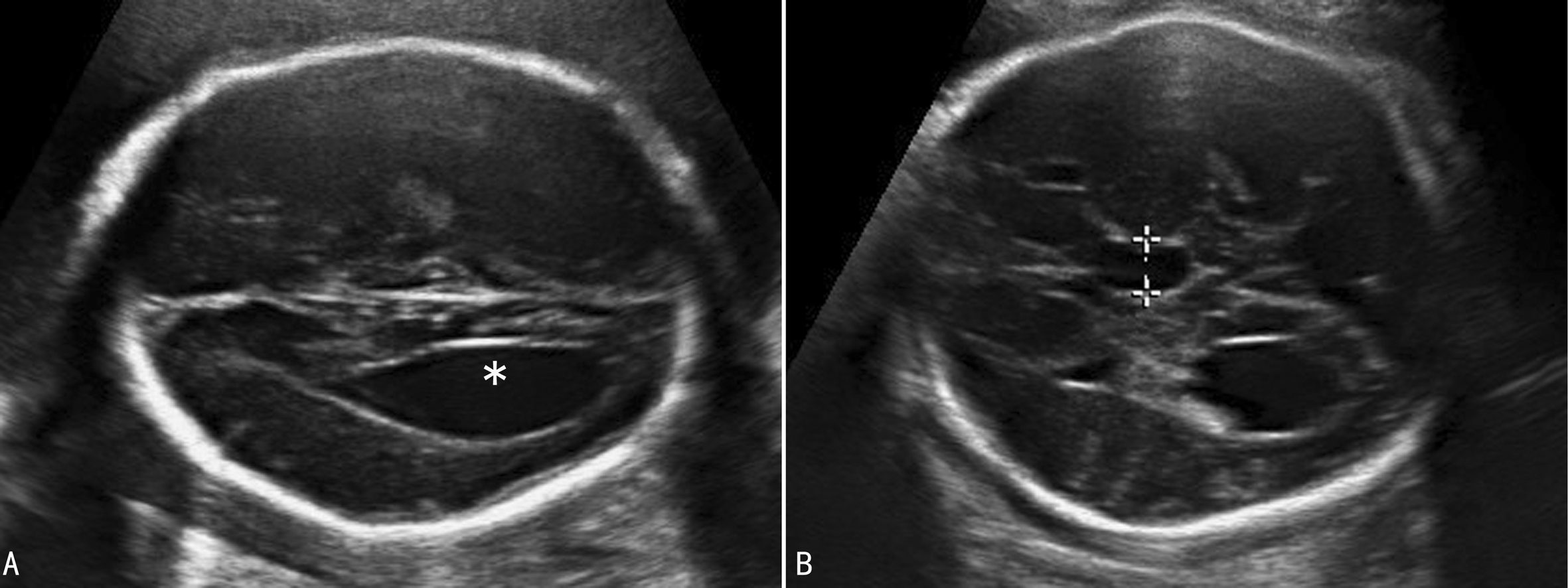胎儿颅脑结构及心脏结构异常,胎儿颅脑形态及结构异常