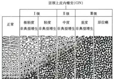 cin癌前病变,癌前病变cin二级癌症概率大不大