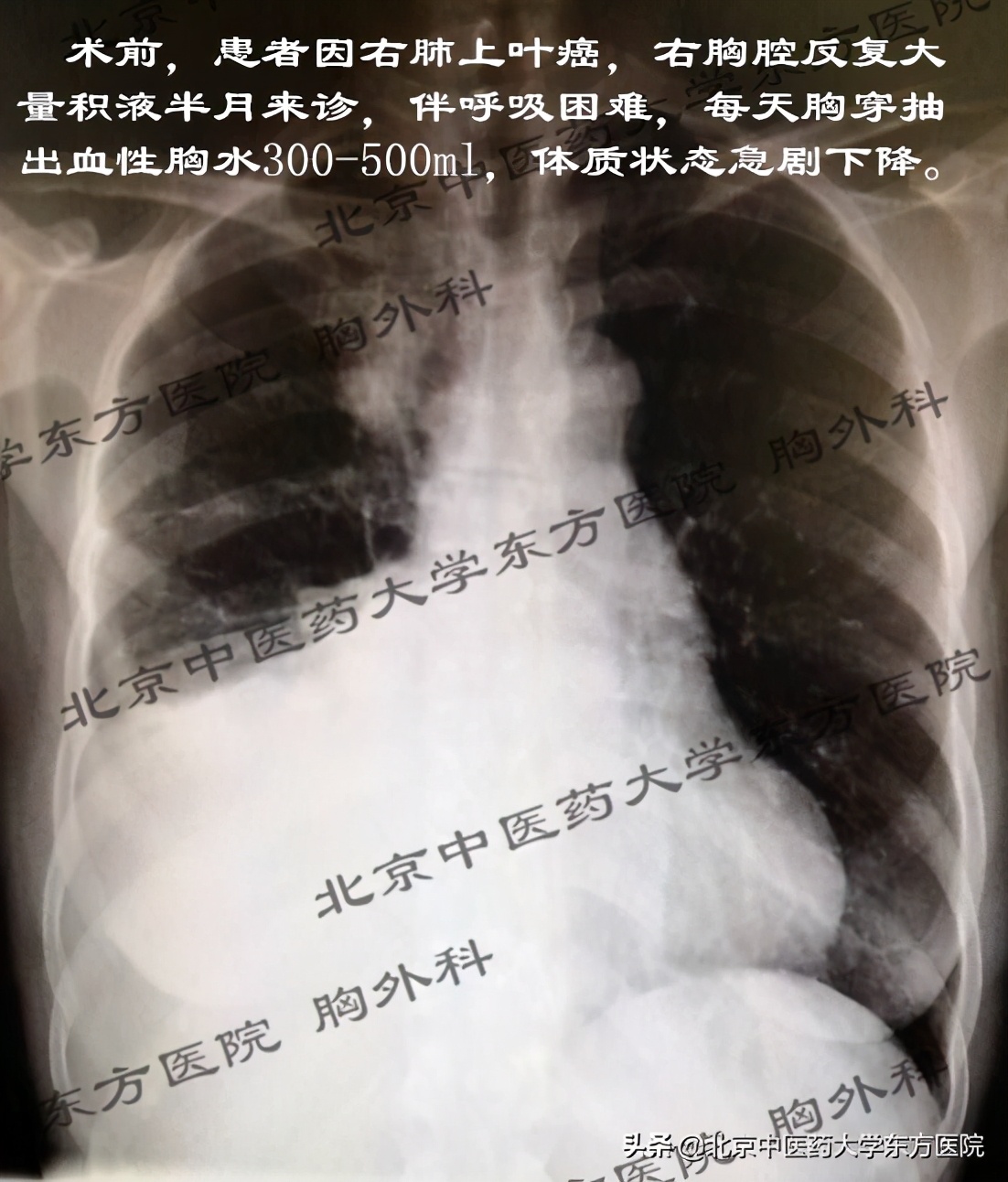 北京治疗胸腔积液哪个医院权威,中医治疗心脏胸腔积液