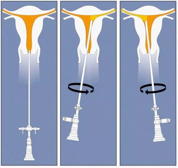 宫腔镜检查全过程跟手术有区别吗,宫腔镜三个孔和四个孔的区别
