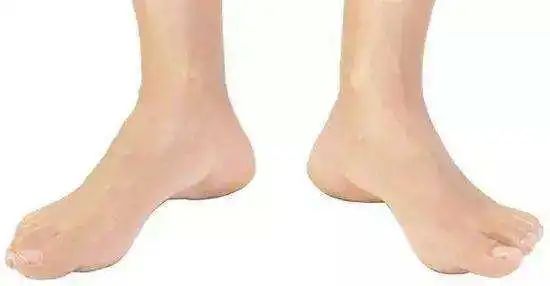 走路外八有必要矫正吗,一岁多宝宝走路外八怎么纠正