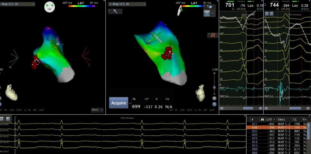 扩心病引起的早搏能治好吗,什么药治早搏