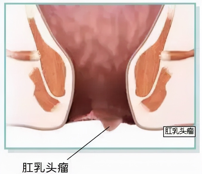拉屎拉出一个小肉球,拉屎拉出小肉球