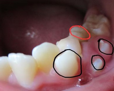 小孩多生牙怎么处理,多生牙怎么办