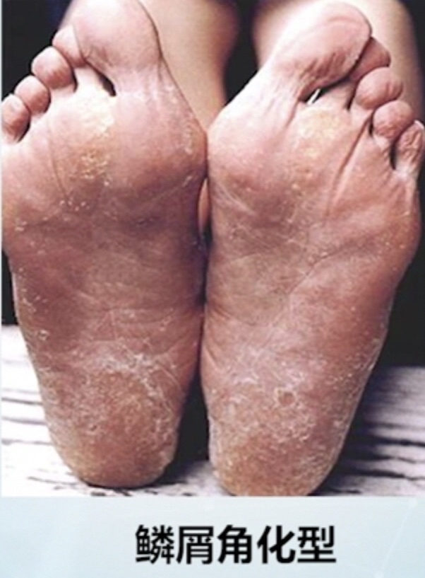 脚气的根本原因,脚气与香港脚的区别