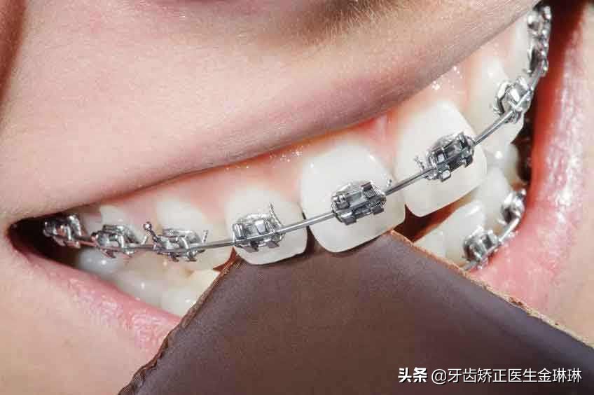 牙齿矫正拔牙牙缝多久能关上,淄博牙齿矫正一般多少钱