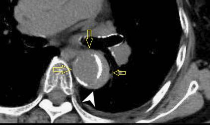 胸部Ct平扫能查出主动脉夹层吗,主动脉夹层cta影像图片解读