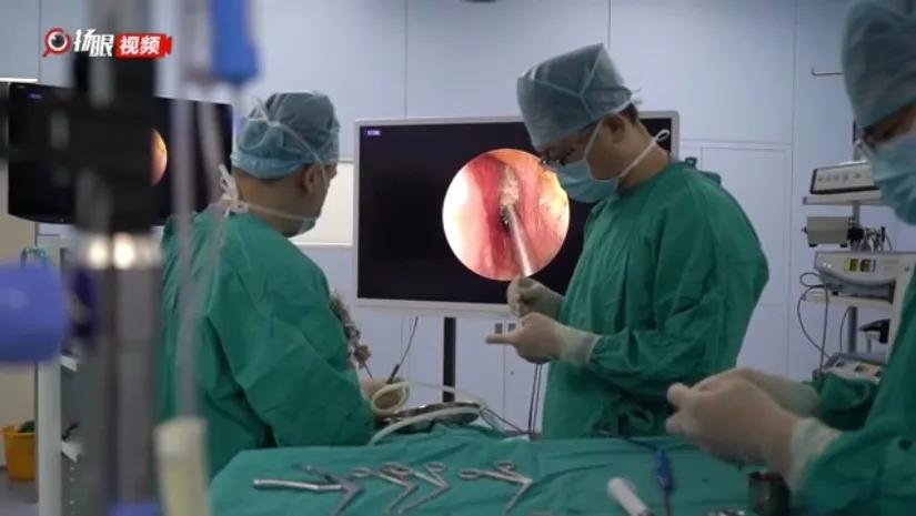 脑子积水手术,脑子漏水的最佳治疗方法